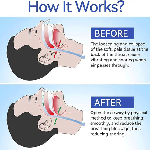 Anti snoring magnetic G